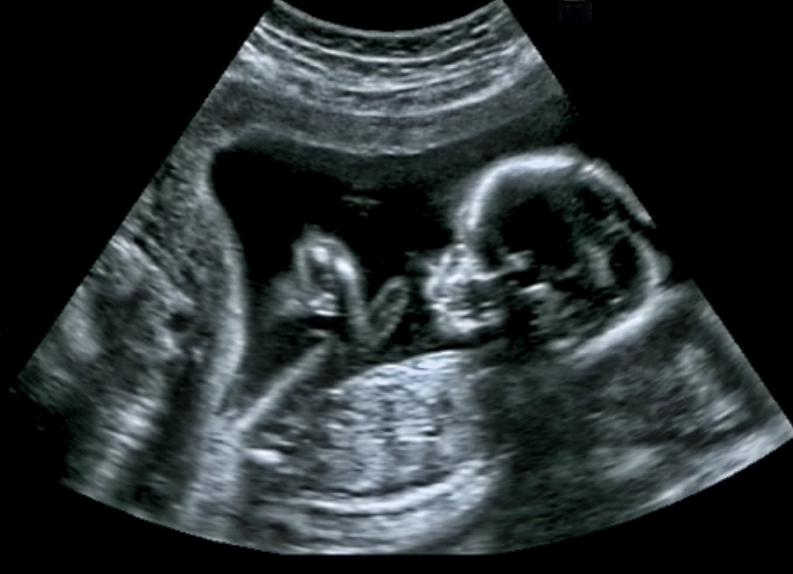 Ultrasound Scan